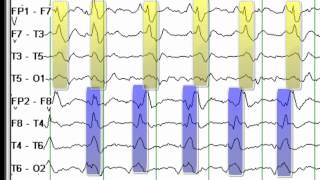 EEG Reading Rounds BIPLEDS [upl. by Kenwee]