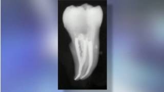 Phoenix Endodontist Obturation [upl. by Oiram]