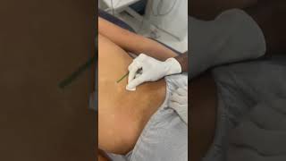 Quadratus lumborum QL dry needling [upl. by Ayhtnic638]