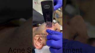 ✨ Morpheus8 – Advanced Acne Scar Treatment by Dr Vikas Gawri ✨ [upl. by Ahsyas]