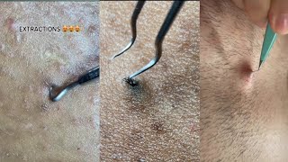 ingrown hair removal Completion 😌 2023 Edition [upl. by Aidin]