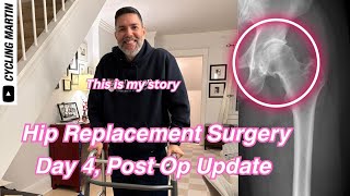 Ep 44 Hip Replacement Surgery [upl. by Natsirk724]