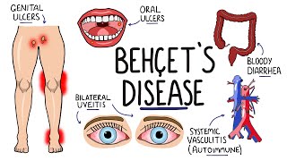 Behcets Disease  Signs and Symptoms with Triad  Pathophysiology  Criteria amp Treatment [upl. by Zoarah]