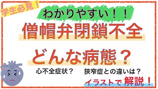 僧帽弁閉鎖不全症についてわかりやすく解説！〜心不全症状がみられる理由や心房細動になる理由とは〜 [upl. by Aiciruam]