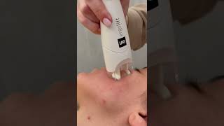 LPG Facial london skincare [upl. by Arias]