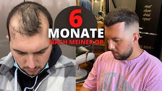 Haartransplantation Vorher Nachher  6 Monate nach der OP [upl. by Nitsrek]