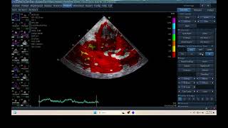 IQ 315 TSI TISSUE SYNCHRONY IMAGING ECHOPAC ANALYSIS ECHOCARDIOGRAPHY [upl. by Belvia]