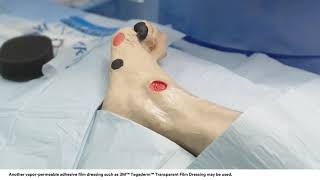 Application tips 3M™ VAC® Dressing Application Bridging Technique on Foot Wound [upl. by Akimert832]