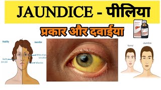 Jaundice treatment  Types of Jaundice  Symptoms of Jaundice  What is main cause of jaundice [upl. by Bradleigh580]