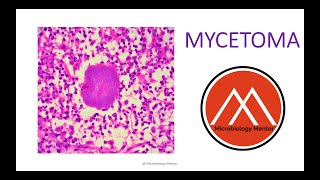 MYCETOMA Fungal infection 🔬🧫 Subcutaneous mycoses [upl. by Trace]