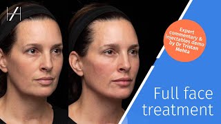 Full Face Dermal Fillers Treatment Demonstration by Dr Tristan Mehta [upl. by Ynaffital57]