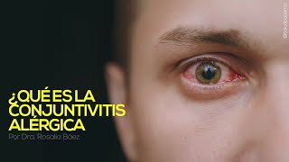 Conjuntivitis Alérgica síntomas y tratamiento [upl. by Marlea]