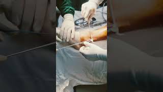 Cruciate ligament repair ligament surgery  mozart peroneus longus [upl. by Desdamonna]