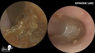 1562  Mrs Cotton Bud Ear Wax Removal in a Prolific Cotton Bud User [upl. by Sneed212]