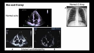 Dilated Cardiomyopathy Causes symptoms Diagnosis amp Treatment Bryte Medical Lectures [upl. by Sandstrom]