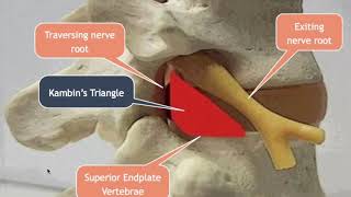 Lumbar Transforaminal Approach for Disc Herniations [upl. by Haduhey917]