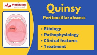 Quinsy  Peritonsillar abscess  Etiology clinical features treatment Mediklaas [upl. by Golightly]