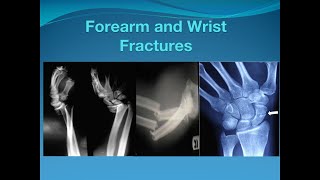 Forearm and Wrist fractures [upl. by Melentha]