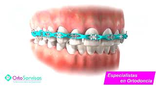 Brackets 3D  Cadena de Ortodoncia  Ortosonrisas Barranco [upl. by Ketchan]