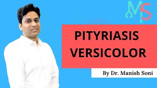 Pityriasis Versicolor By Dr Manish Soni  Dermatology [upl. by Derry329]