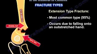 Supracondylar Fractures Of The Humerus In Children [upl. by Imeka]