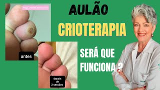 Aulão Será que Realmente a Crioterapia Funciona na Verruga [upl. by Fen341]