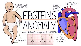 Understanding Ebsteins Anomaly [upl. by Esma749]