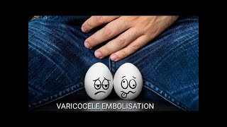 Varicocele  Treatment of varicocele in male  Varicocele embolisation  a non surgical treatment [upl. by Seravaj456]