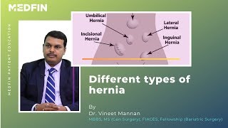 Types of Hernia [upl. by Halle]