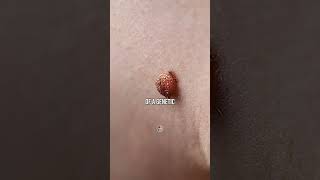 Skin Tags And Your Diet [upl. by Peirce399]