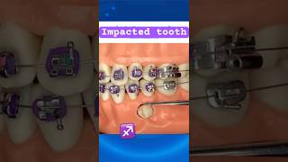 Impacted tooth during Braces [upl. by Kelsey]