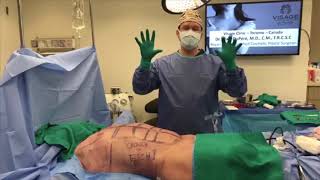 Dr DuPéré LIVE Surgery Liposuction  Abdominal Etching [upl. by Nolan]