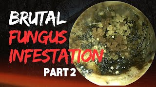 BRUTAL Fungus Infestation Due To Physician Mistake  PART 2 [upl. by Silverstein986]