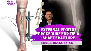 External Fixator Procedure For Tibia Shaft Fracture [upl. by Jerri]