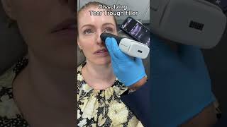 Dissolving Tear Trough Filler  Dr Medispa [upl. by Alemac759]