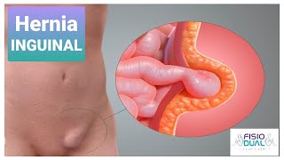 Ejercicios para Hernia Inguinal [upl. by Corneille]