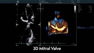 〖Echocardiography〗 The Mitral Valve in 3D  TTE 🫀 [upl. by Gnous]