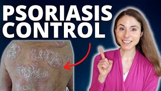 TOP 5 TIPS TO CONTROL PSORIASIS FLARES 😊 DERMATOLOGIST DrDrayzday [upl. by German]