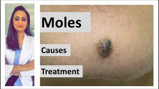 How to remove a mole  Mole causes amp removal  home remedy  Dermatologist  Dr Aanchal Panth [upl. by Gerson]