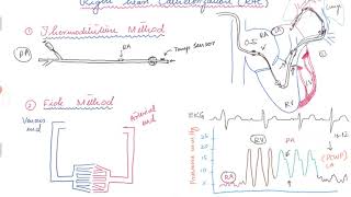 Right Heart Catheterization [upl. by Riha]