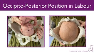 OccipitoPosterior Position BacktoBack in Labour [upl. by Clapp]