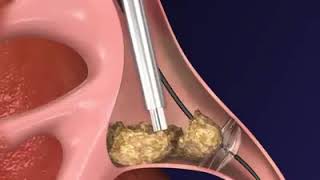 Cystoscopic Laser Lithotripsy and Stone Extraction Cystolithalopaxy [upl. by Lorelie]