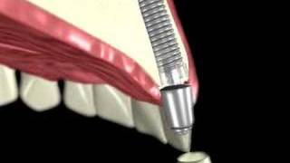 3D Medical Animation of a Dental Implant [upl. by Luby]