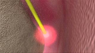 Laser Periodontal Therapy  WPT™ Animation [upl. by Sadnac179]