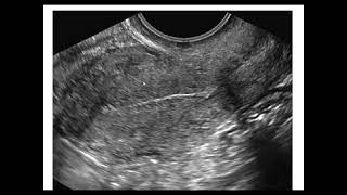 Assessment of endometrium by ultrasonography [upl. by Notnerb]