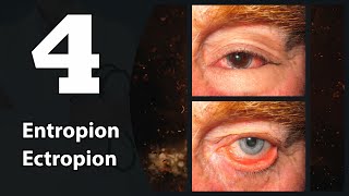 4 Eye lids Entropion amp Ectropion [upl. by Ecadnac]