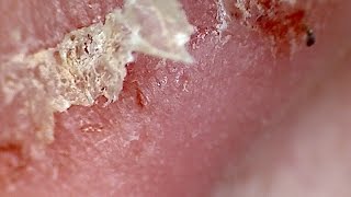 Magnified Scab Picking [upl. by Siegel]