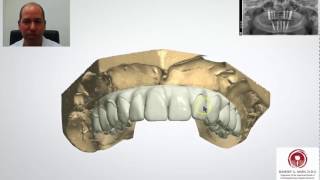 Full Arch All on 4 5 6 7 8 Implants  3D Lab Teeth Design Video [upl. by Hannahsohs]