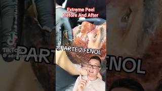 TW😱 SHOCKING CHEMICAL PEEL  Phenol Peel Before and After shorts [upl. by Ynohtnacram50]