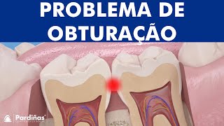 Restauração dental – Problema de obturação © [upl. by Enilatan]